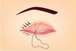 ������ɴ�����Ĥ����˽ϲ�������