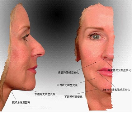 ��Ƥ����5.5����沿�仯�ܽ�