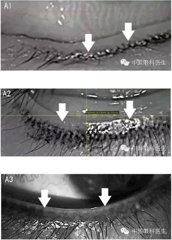 CORNEA����������������һŮ���۲�����