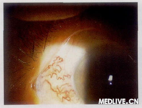 ͼ1 �������Ĥ������״��Ѫ������Ѫ��