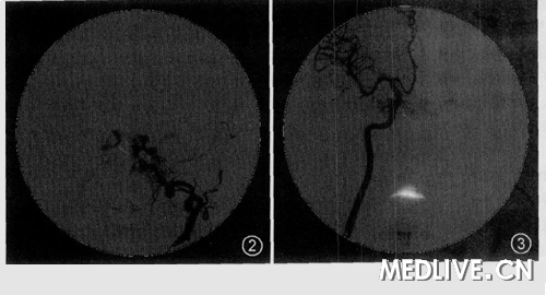 ͼ2 DSA ��λ��ʾ: ���⶯����Ӱ��ʾ����������²��ɼ����۾�����Ӱ ͼ3DSA��λ��ʾ: �Ҿ��ڶ�����Ӱ��ʾ����������²��ɼ��ĶԲ��۾�����Ӱ