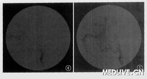 ͼ4DSA��λ��ʾ: ����(���)������Ӱ��ʾ��Ĥ�ж����������ɼ������©��ԭ�����ɼ����۾�����Ӱ ͼ5 DSA��λ��ʾ: ѪҺ������Ĥ��������, ��ʾ��ԭ�����ɼ����۾���