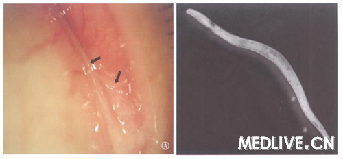 ͼ1 ��1������ǰ�����ࣨA�������Ĥ��˱�߳�������΢���´������ࣨB������͸����״����λ���������������Ĥ���ڣ��ڼ�ͷ�������Խ�Ĥ��˱�߳�ɳ棬��Լ8mm����Լ0.3mm��