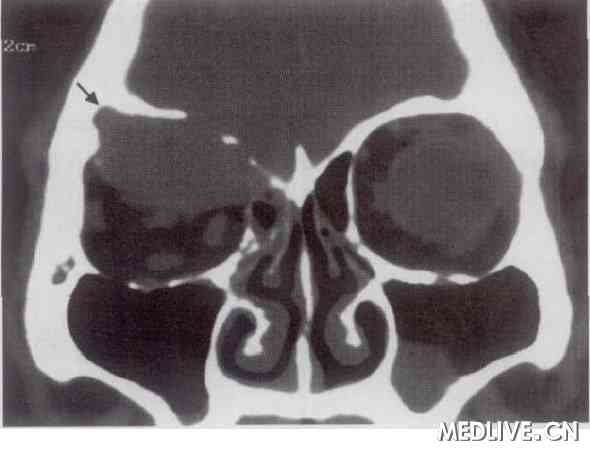 ͼ1 �ۿ����⽬ϸ�������ߣ�CTɨ��ʾ���ۿ�������֯��Ӱ����Ե�����ѹ���ڽ����ʳʹ��ƻ��ı�(��ͷ)