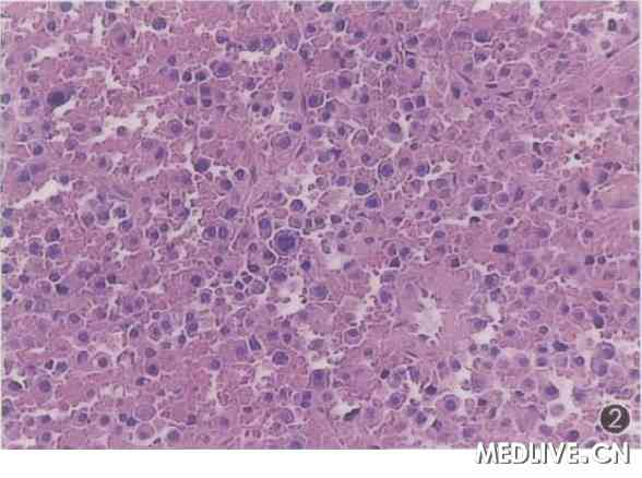 胞质丰富, 核卵圆形,深染,偏位,瘤细胞有一定的异型性he染色×200