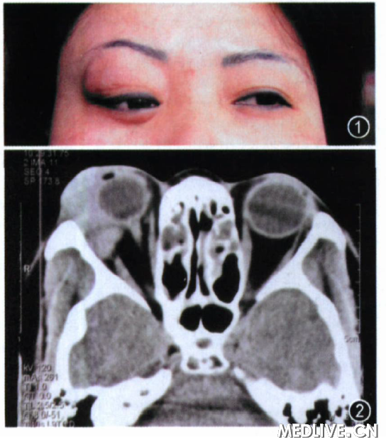 ͼ1 �����������״Ӳ���׿飬 ����Ե�Գʡ�S���Σ� ������ǰͻ������·���λ  ͼ2 �ۿ�CT ɨ��(��λ)��ʾ��������Ϸ�����֯��Ӱ�� �׿��ڳʶ���״