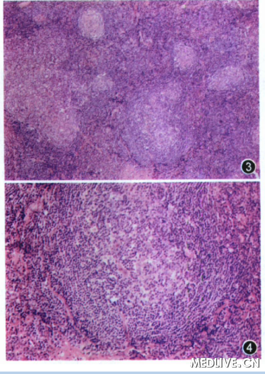 ͼ3 ����ܰ������ݴ�С��һ�� �������������С���Ƥ�����ܰ�ϸ�����ƣ� ��Щ���ݻ����ں��γɽϴ���״������ܰ������ݣ����ݼ����н�ϸ�����ܰ�ϸ�������������Ѫ��  HEȾɫ��70  ͼ4 �нϴ���ܰ������ݣ��������ļ����������ܰ�ϸ���ͽ�ϸ�������ɼ�Ѫ�ܳ���������  HE Ⱦɫ��176