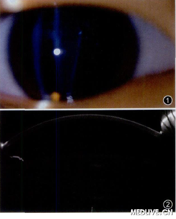 ͼ1 �����Ծ�״���Բ׶������ǰ������϶����΢�����, �ɼ����Ϸ���״����ҳ�Բ׶��������ǻ͹��, �䱡, ���ײ���Ȼ��� ͼ2�����Ծ�״���Բ׶����������ǰScheim p flug��ǰ�ڷ����Ǽ��ʸ״��ͼ��,�ɼ���״������ֲ�������ǻ��Բ׶��͹��,��Ӧ��λ�ĺ���Ĥ�䱡, Բ׶���ײ��ĺ�����Ƥ������ȻҰ�ɫ����