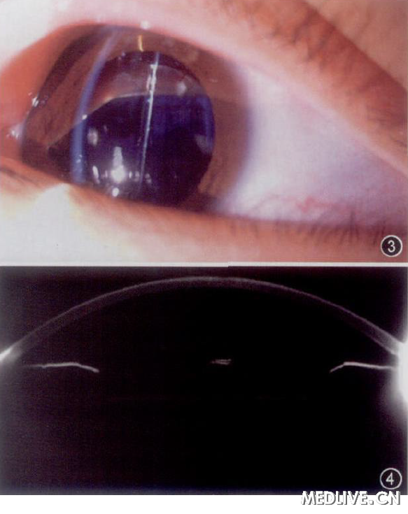 ͼ3 �����Ծ�״���Բ׶��������������϶����΢�����ɼ�IOLλ�þ���, ����ĤԲ׶״�ı���ʧ,��ù⻬͸�� ͼ4 �����Ծ�״���Բ׶������������Scheimpflug��ǰ�ڷ����Ǽ��ʸ״��ͼ��,�ɼ�IOLλ�þ���,���ҹ⻬͸��