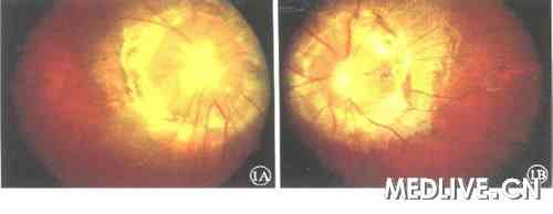 ͼ1��˫������ǰ��ɫ�۵���( A����, B����)����������,����Ϊ��ɫ�����֯����,����ɼ�����״Ѫ��,��ϸ����,�������ֶ����������������·�����·�����Ĥ����, �����ɫ