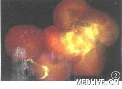 ͼ2�������������ɫ�۵���������Χ����Ĥ����,����������,���֧Ѫ����״����