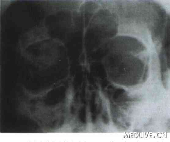 ͼ1 �ۿ����ں���״Ѫ���������ۿ�X��ƽƬʾ���ۿ��ϲ���һ���ܶ���֯Ӱ���ܶȲ�������ϸ��״���߽����