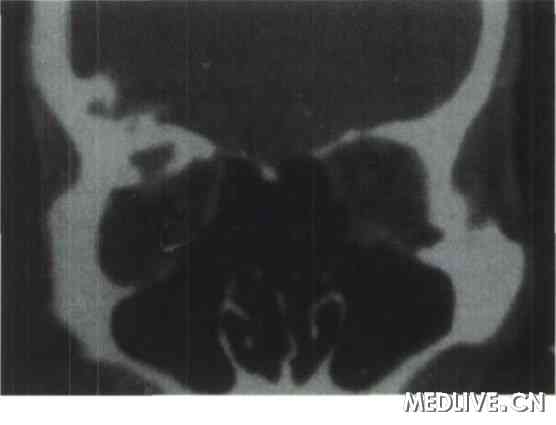 ͼ2 �ۿ����ں���״Ѫ��������CT���ɼ����ۿ����ڵ��Ǵ�������һ����֯��Ӱ����СΪ2.1cm��1.8cm��CTֵ55~65Hu������Ǵ������ʳ������Ըı䣬���ʲ�������������Χ����
