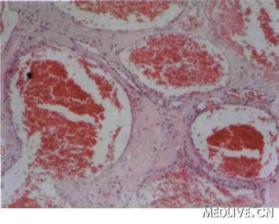 ͼ3 �ۿ����ں���״Ѫ����������֯����ѧ���ɼ������ɳ���ǰ��С����ɣ���϶��Ϊ����Ѫ��ǻ���ڳ���Ƥϸ������ǻ����ƽ����������άϸ����HE Ⱦɫ��100