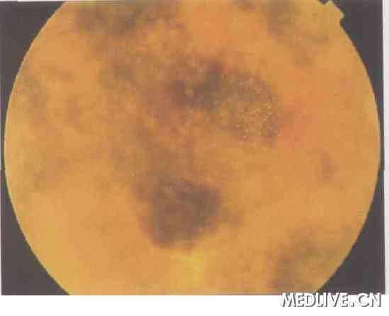 �ط���ѪС���������񰡪�����ۿ�֢״Ϊ����һ��   ͼ1��������Ĥ����Ѫ�� �����������״С��