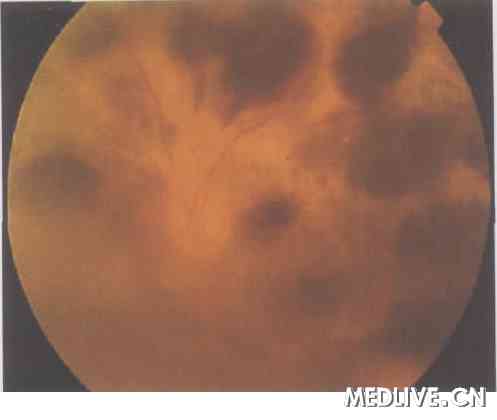 �ط���ѪС���������񰡪�����ۿ�֢״Ϊ����һ��  ͼ2����������Ĥ��㼰����Ĥ��Ƭ��Ѫ�� ���������