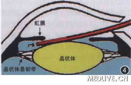 �µ��գ��ع˱���̨������Ϻ����������ķ�չ  ͼ4�а���������ժ����ʱ���ú���ע���-�ӵ���ø���о�״�����ʹ���ϵ�ʾ��ͼ  