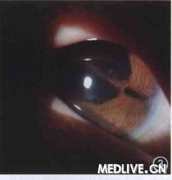 ͼ3 Axenfeld-Riger�ۺ������ߣ���2��������϶����΢�����ͼ�񣬿ɼ���Ĥ���ʲ�ή����ͫ����λ����֢ͫ