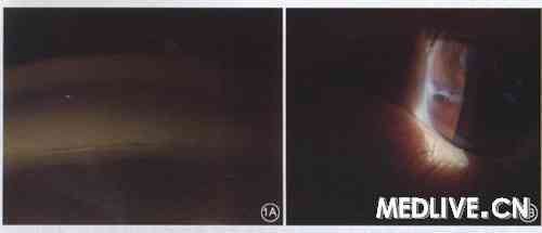  ͼ1 Axenfeld-Riger�ۺ������ߣ���1�����ۼ��ͼ��1Aʾǰ���Ǿ����ͼ�񣬿ɼ���Ĥ��Schwalbe��ͻ�������񣬳ʰ�ɫ������1Bʾ��϶����΢�����ͼ�񣬿ɼ���Ĥ�ܱ߲���һ���������ǣ���ʹ��Ĥ�빮Ĥ�Ľ��޲���