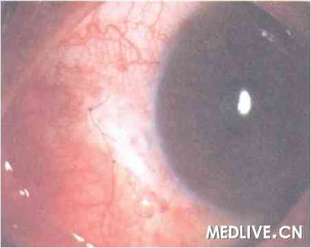 ͼ1 ��״�����г�����Ĥ�ܽ�1��