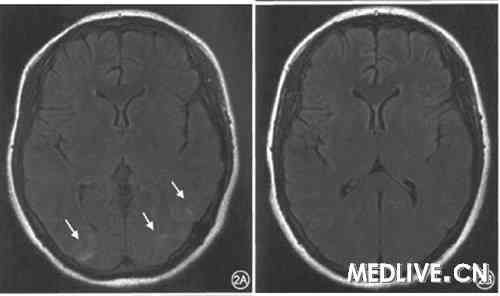 ͼ2Ƥ��ä����ͷ­MRIɨ����λT2 Flair��Ȩ��2Aʾ��Ժʱ��顣 �ɼ�˫����Ҷ������ҶT2���ź�(��ͷ)��2Bʾ���⾷����ѹ����3 d�󸴲飬�ɼ�����������ʧ