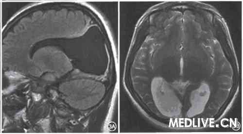 ͼ3Ƥ��ä����ͷ­MRI��飬3Aʾʸ״λFlair��Ȩ�� 3Bʾ��λT2��Ȩ������ʾ˫����ҶƤ��ή���������Һ������