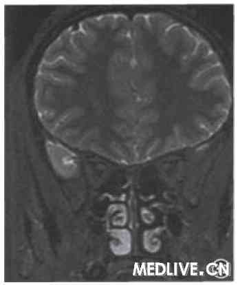 ͼ3Ƥ��ä����ͷ­MRI��飬 3Cʾ����Stir�����飬��ʾ˫������ή����ϸ