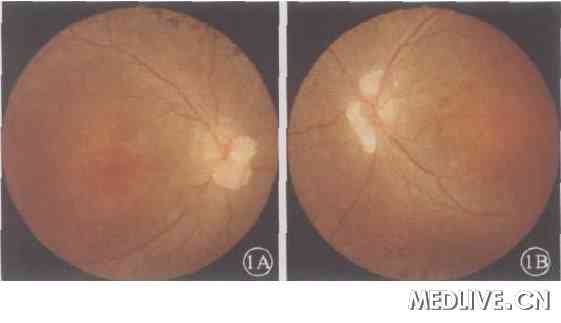 ͼ1��˫�۲�ɫ�۵���( 1A. ���ۣ� 1B. ����) �����̱ǲ��Ե����״������ɫ��˸�����İ�͸��¡���  �ڱβ���Ѫ�ܣ� ����ϸ�� ����Ĥɫ�����ң� �ܱߴ�����ϸ����ɫ�س��ţ� �ư߻Ұ��� ���İ�������ʧ