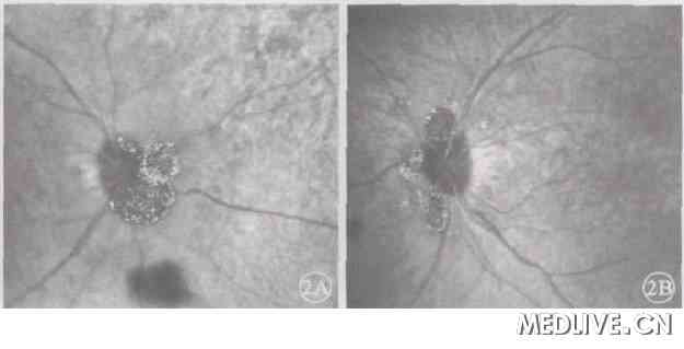 ͼ2��˫���޳���۵���( 2A. ���ۣ� 2B. ����) �� ���̱ǲ��Ե¡�������ֿ������Է�ӫ��