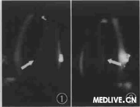 ͼ1���۾�״��ǰ����������������ǰͻ�� ��׶�Σ� ��Ĥ�¿ɼ�С�ߵ�״��ɫ����( ��ͷ)   ͼ2 ���۾�״��ǰ��������ͬͼ1