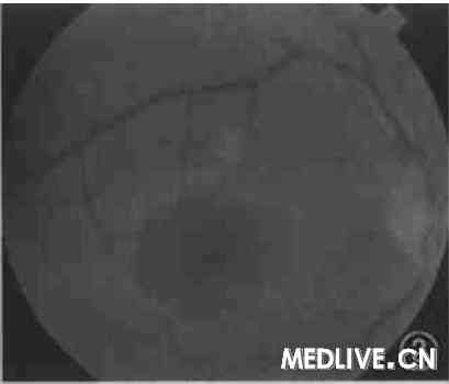 ͼ3��������ɫ�������� �߽������� ����ĤѪ�ܴ��������� �󼫲��ư�����Χ�ɼ�ɢ�ڵĻư�ɫ��״������ �ư����İ�����ɼ� 