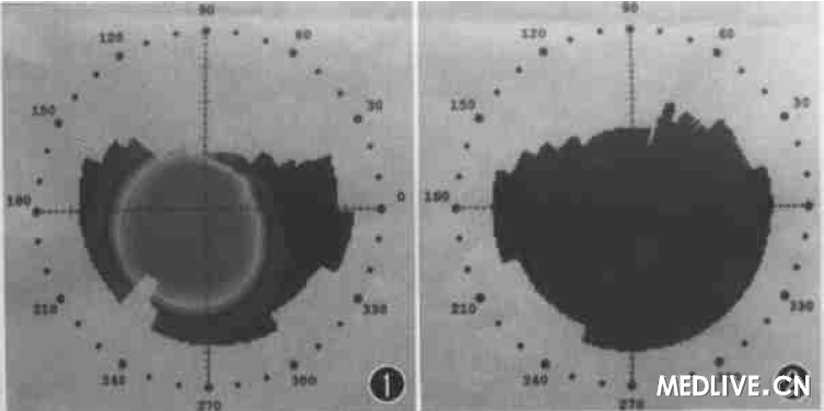 ͼ1  ��Ĥ����ͼ��ʾ���۽�Ĥ��������������> 57.00 D, 4mm ���������ʽ���   ͼ2 ���۽�Ĥ�������������仯