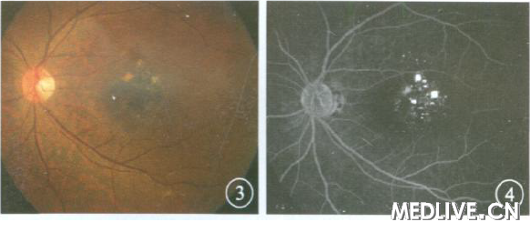 ͼ3����2 �������۲�ɫ�۵��񡣻ư�����Լ1. 5 DD ��Χ�Ϻ�ɫ���Ѵ���¡�� ��������ɫ��ά��� ͼ4��ͼ3 ͬ��FFA������Ѫ������ǻ�ڳ���ǿӫ�⣬ ���ɼ�ѩƬ����ñ״ӫ�⡱