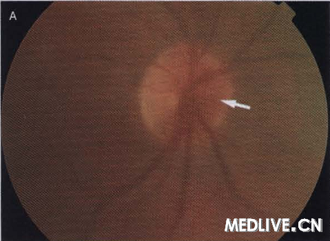 A��˨�۾����ʾ�۵�ȱѪ�����̴��������š�С������խ������Ѫ���γɣ���ͷ��