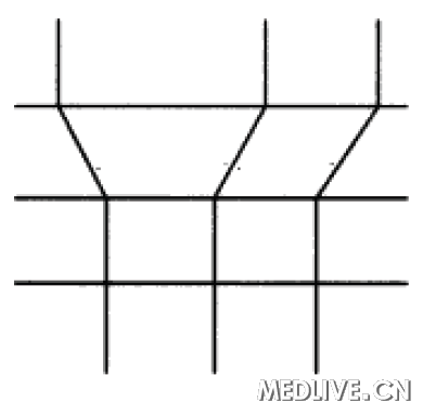 ͼ1����ǰAmsler����� 