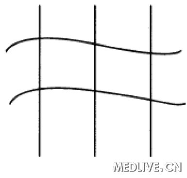 ͼ2������Amsler�����