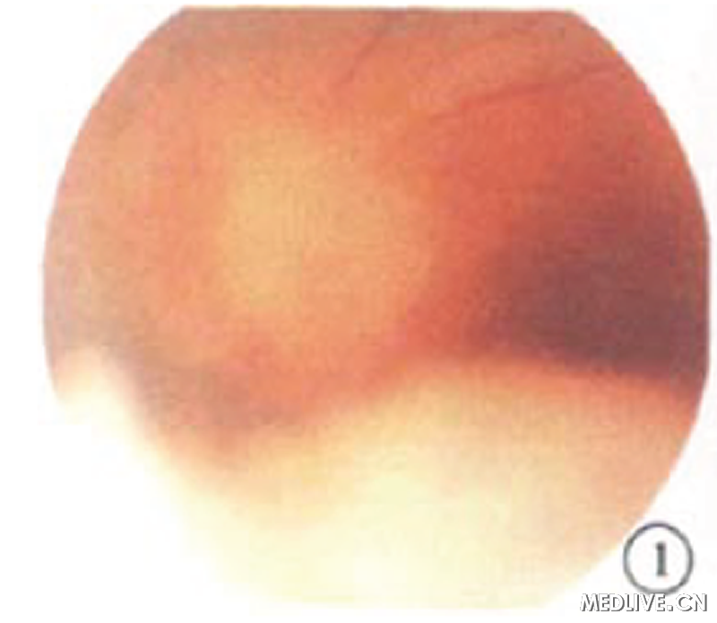 ͼ1�������۲�ɫ�۵������̱��漰�·�����Ĥ���ɼ��ư�ɫ¡����ռλ����