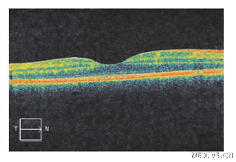 ͼ4����OCTδ�������쳣