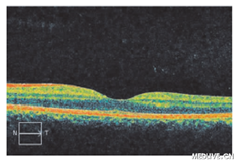 ͼ5����OCTδ�������쳣