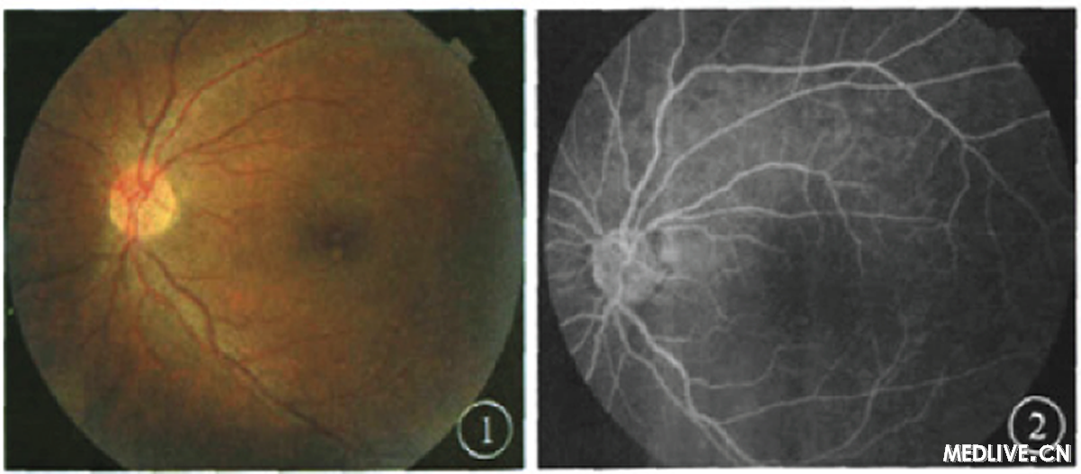 ͼ1�������۲�ɫ�۵��񡣻ư����İ����·��ɼ��һ�ɫͻ����߽��������Χ��αӰ ͼ2��������FFA�񡣻ư�����״����ӫ����©�����ڱ�ӫ��