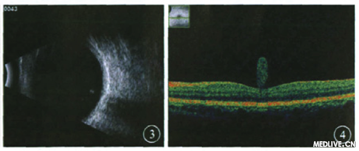 ͼ3��������B�ͳ�������״��ʿ�״�и߶Ȼ������