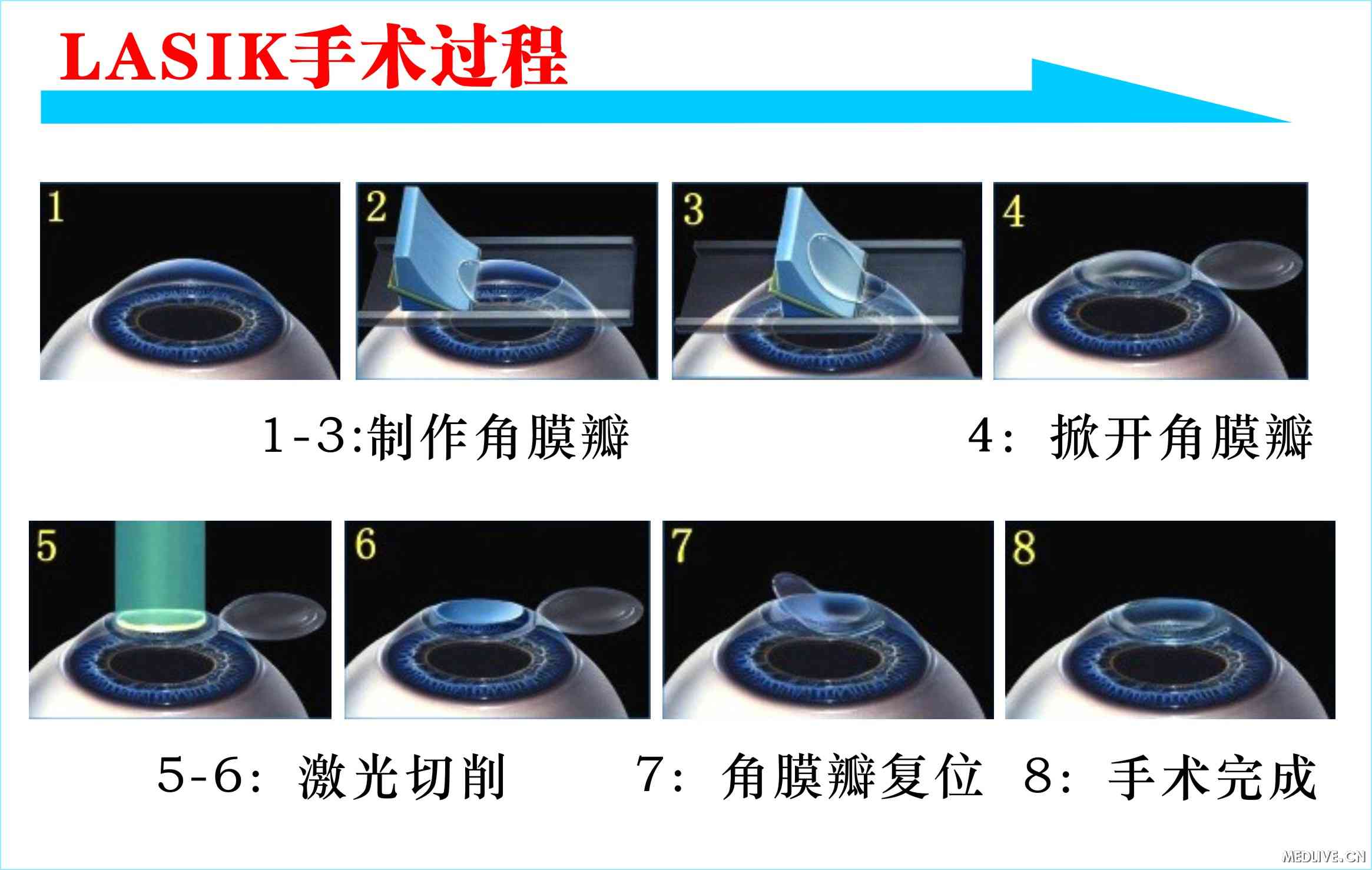 LASIK��������