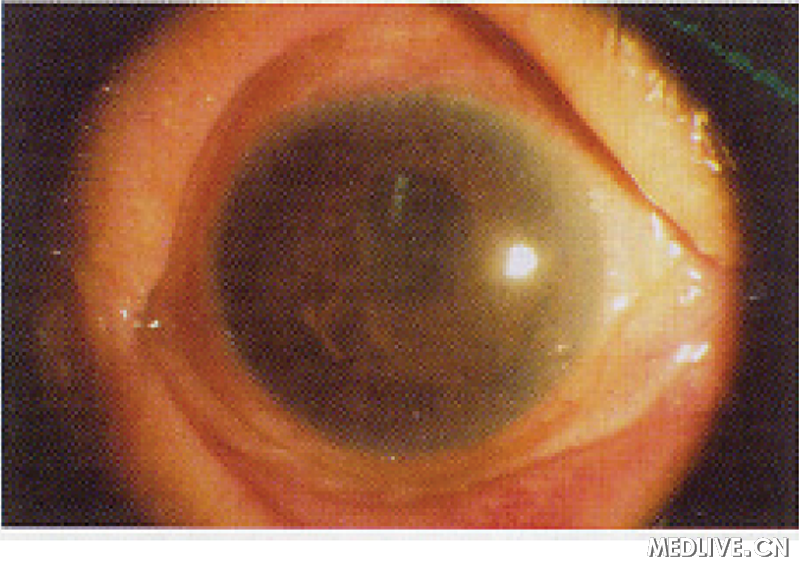 ͼ1ͫ��Եɫ���ⷭ����Ĥ��ճ�ھ�״����棬ͫ��ֱ�Ӽ�ӶԹⷴӦ��ʧ����״����ǣ��۵׿�����