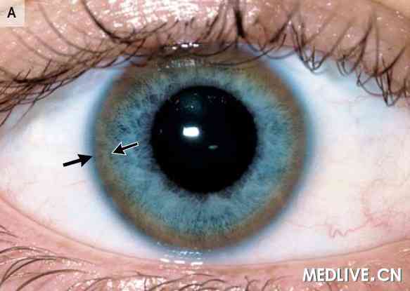 ͼ1 ��ͷ����ʾK-F��(��Ĥɫ�ػ�)