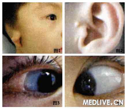 ͼ1�Ҷ������Σ��������խ ͼ2���ǰ����һ�� ͼ3���������Ĥ��ư�ɫ�����������������������ϸСë�� ͼ4���������Ĥ��ɼ��ư�ɫ�����������������δ������ë��