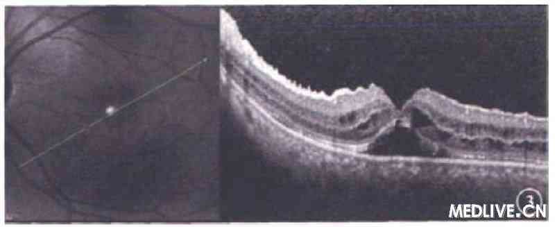 ͼ3 ����OCT�񡣻ư�������Ĥ����Ƥǳ���룬�ɼ������ǻ