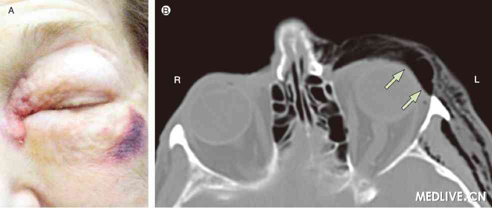 A. ���ۿ�����Χ���˼����͡�B. CT��ʾ����������ۿ��������޿����Թ���