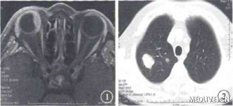 ͼ1 ����MRI����񡣱ǲ�ռλ�Բ��� ͼ2�β�CT����񡣷��ڶ�����ܶȽ��״����