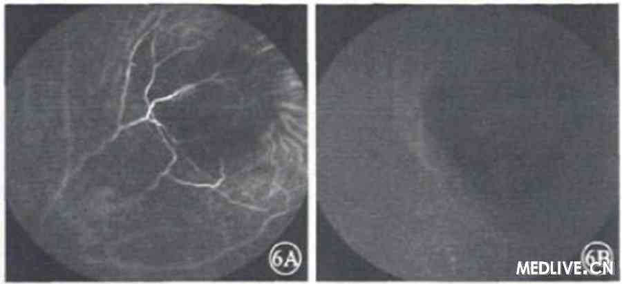 ͼ5����FFA�����5A�����ڿɼ������������ĤѪ�����ţ�ӫ����©��5B�����ڿɼ�����ֲ�����ĤȾɫ ͼ6 ����ICGA�����6A�����ڣ�6B�����ڣ�������������ӫ��