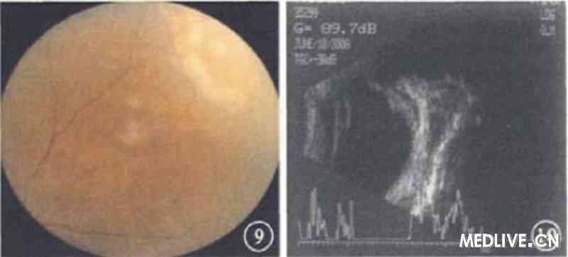 ͼ7��Ƥ�δ��̻����֯�����񡣷���ǻ��ά���������ڴ�������Ƥϸ������ϸ��HE��100 ͼ8���ƺ�2���·β�CT����񡣲��������ǰ������С ͼ9���ƺ�2�������۲�ɫ�۵�������Ĥ�²��������ǰ������С ͼ10���ƺ�2��������B���񡣲���������С���ڻ�������